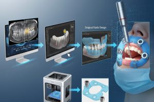 ورک‌فلو کامل جراحی گایدشده دیجیتال از اسکن CBCT تا قرارگیری شابلون جراحی